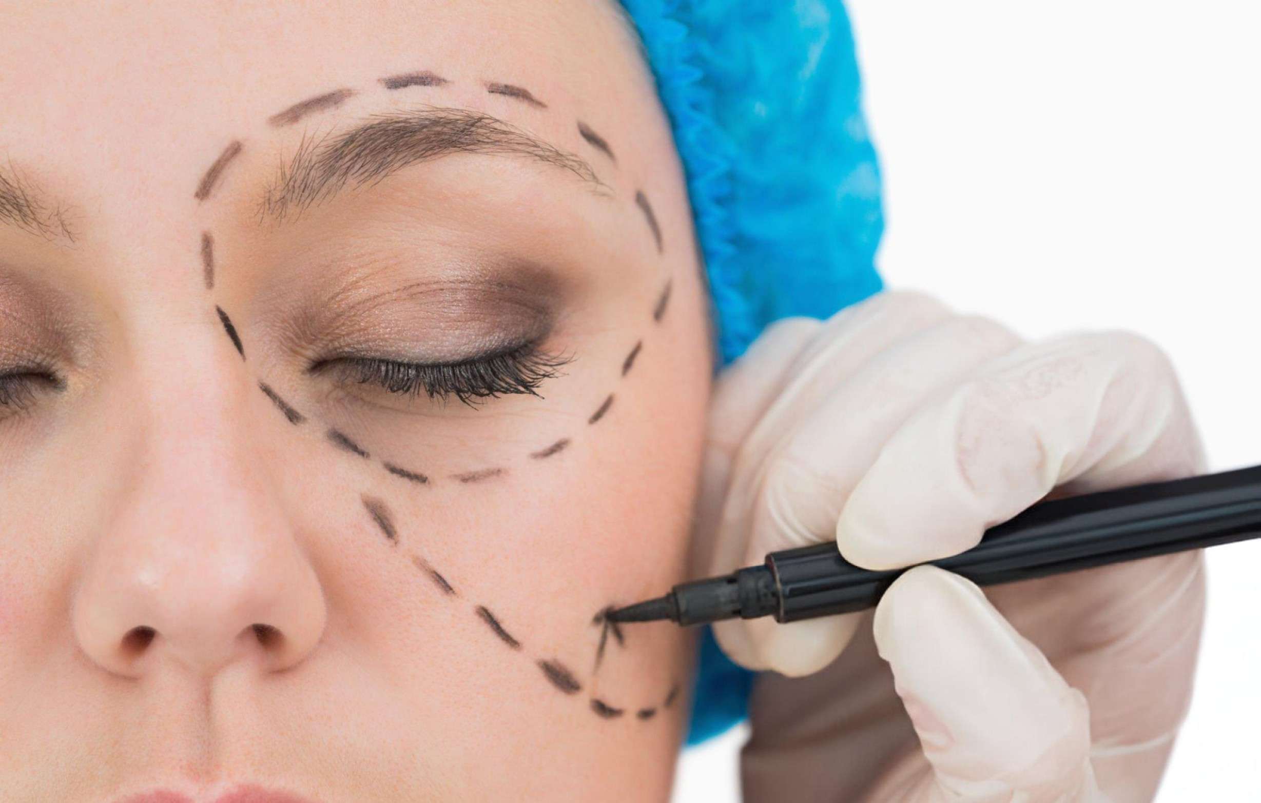 8 point facelift results